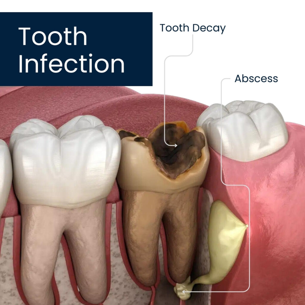 How Long Until a Tooth Infection Kills You?